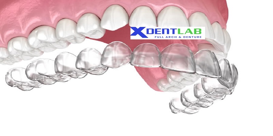 Global orthodontic labs for clear aligners